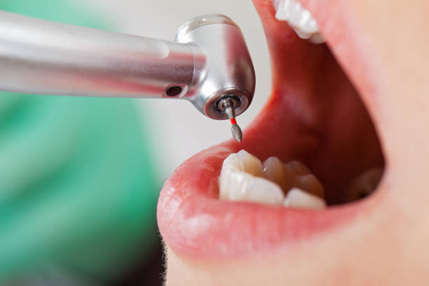 Best Emergency Dental Extractions in Monument Hills, CA